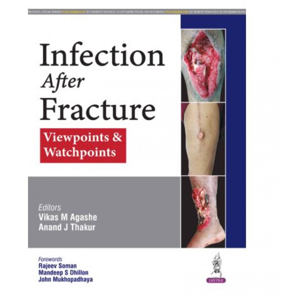 Infection After Fracture: Viewpoints & Watchpoints;1st Edition 2026 by Vikas M Agashe & Anand J Thakur