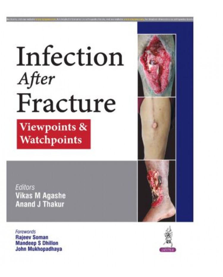 Infection After Fracture: Viewpoints & Watchpoints;1st Edition 2026 by Vikas M Agashe & Anand J Thakur