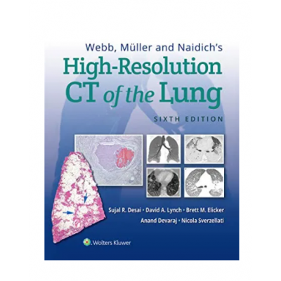 Webb, Müller and Naidich's High-Resolution CT of the Lung; 6th Edition 2021 By Sujal Desai