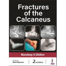 Fractures of the Calcaneus:2nd Edition 2023 By Mandeep S Dhillon