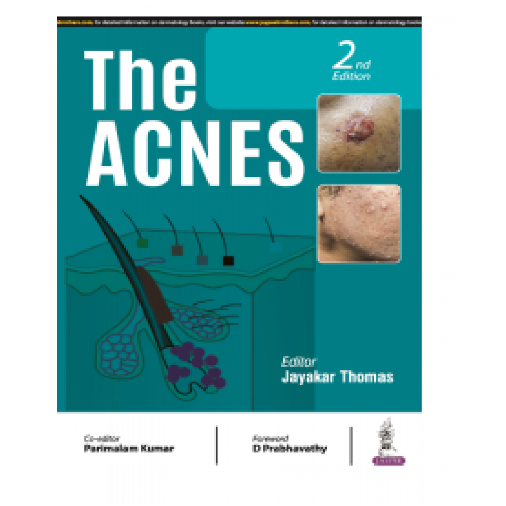 The Acnes;2nd Edition 2024 By Jayakar Thomas