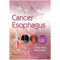 Cancer Esophagus;1st Edition 2020 By Praful Desai & Ratna Parikh