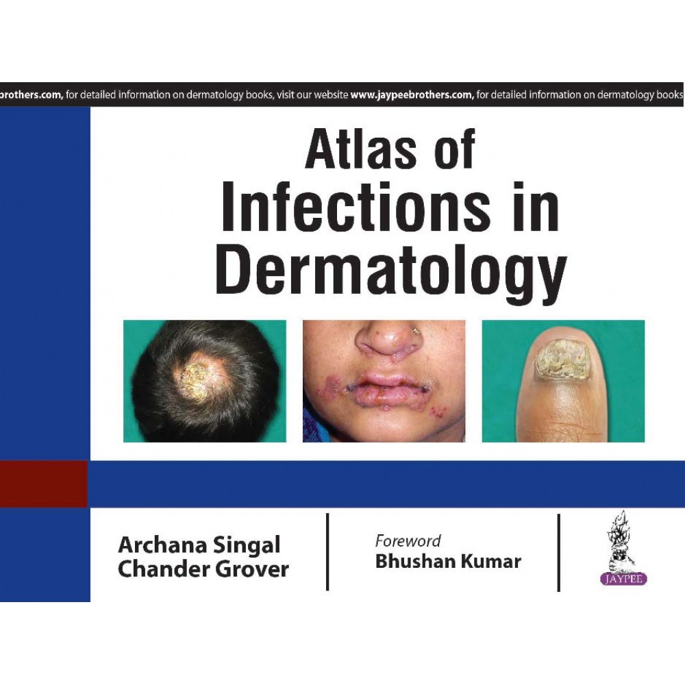 Atlas of Infections in Dermatology;1st Edition 2019 By Archana Singal